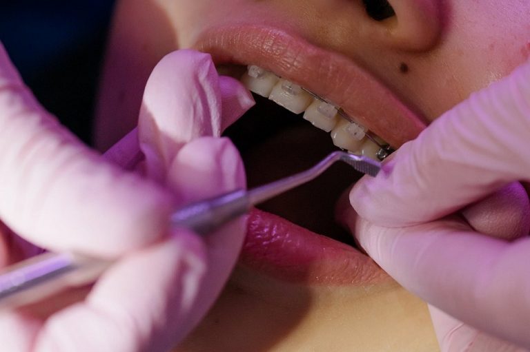 Dantura definitivă și aparatul dentar