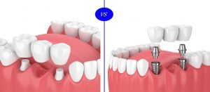 implant sau punte dentara