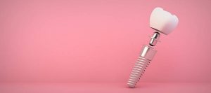 Ce este implantul dentar și cum funcționează?